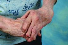 rheumatoid arthritis hands